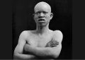 Dia de conscientização alerta sobre preconceito contra albinismo